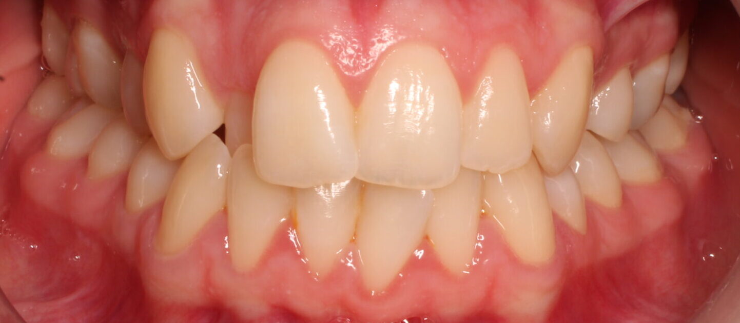 Before braces front teeth