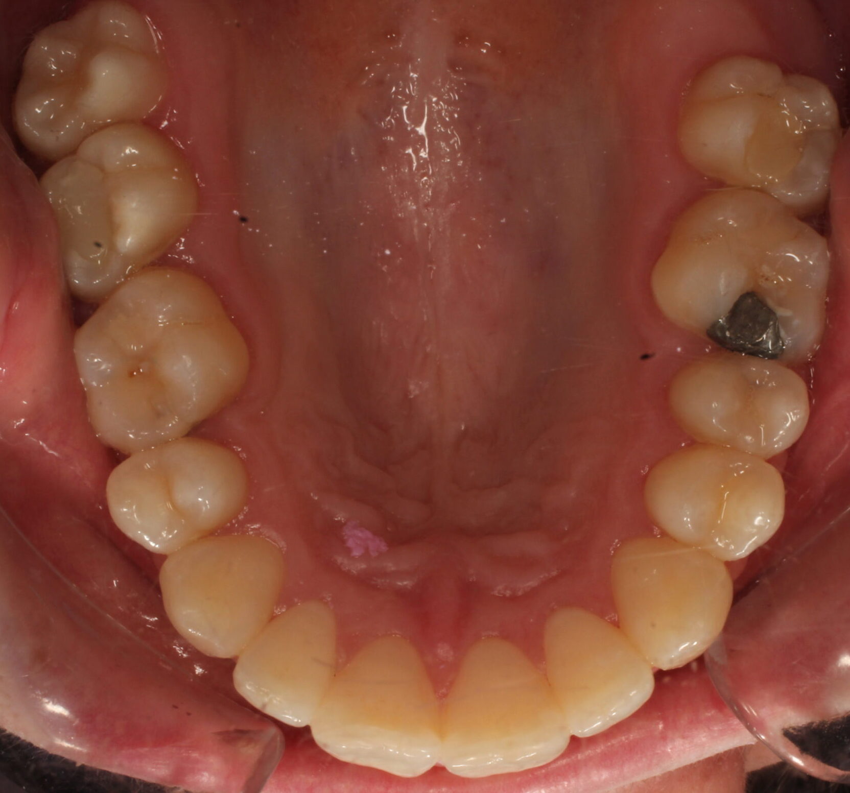 After braces upper teeth