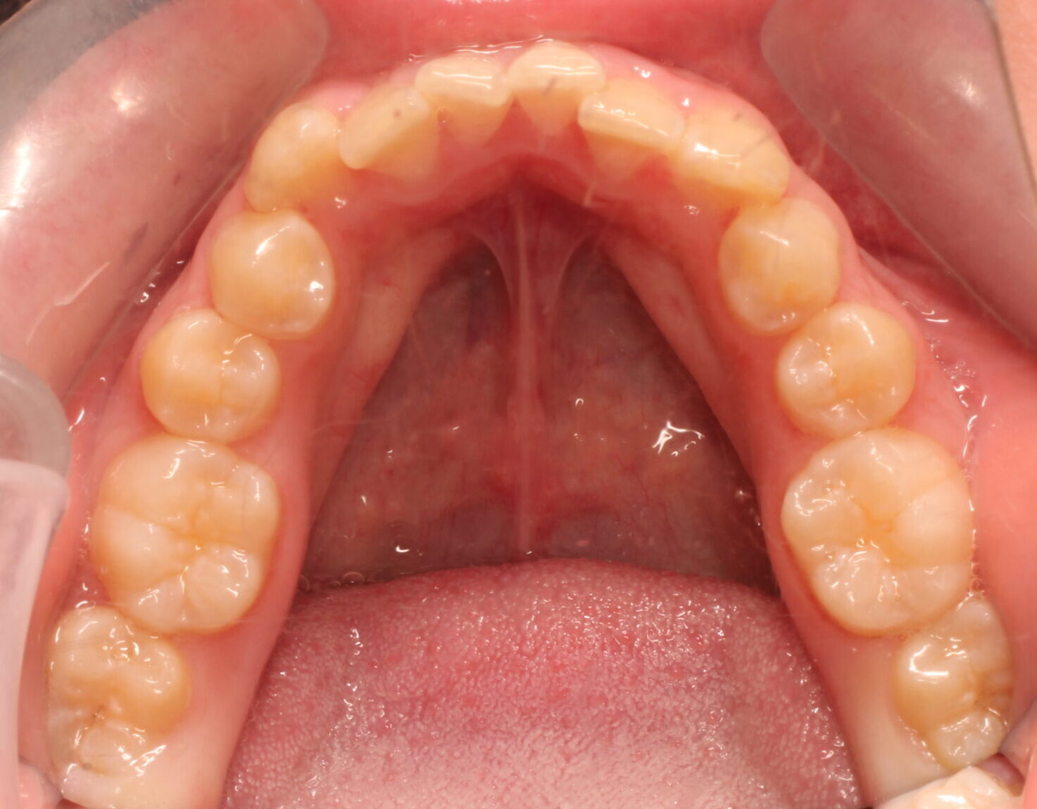 Before braces lower teeth