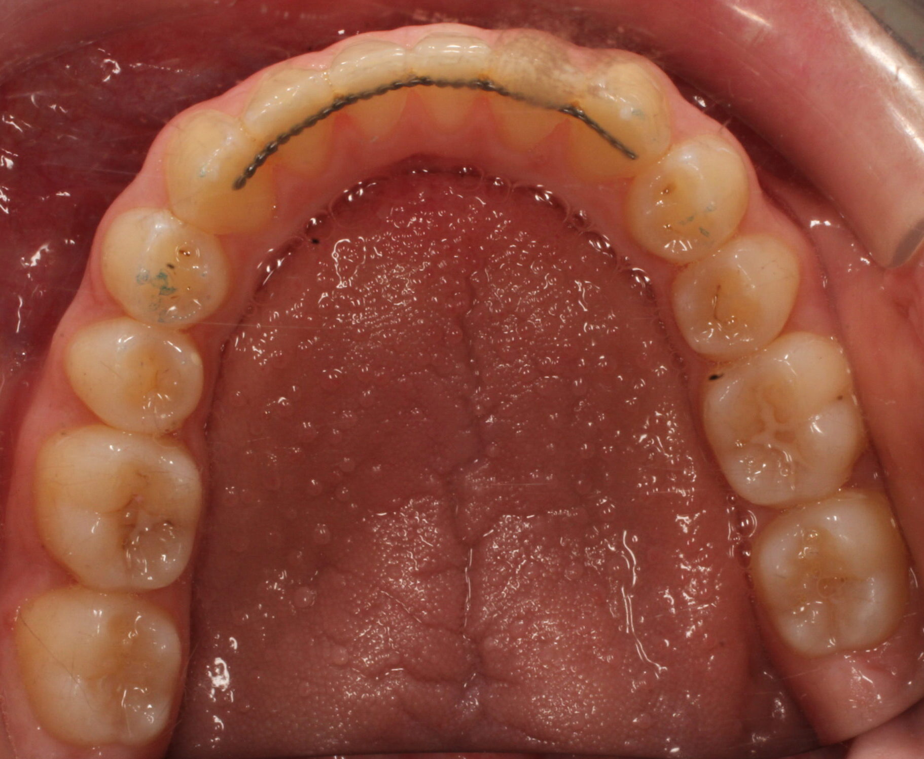 After braces lower teeth
