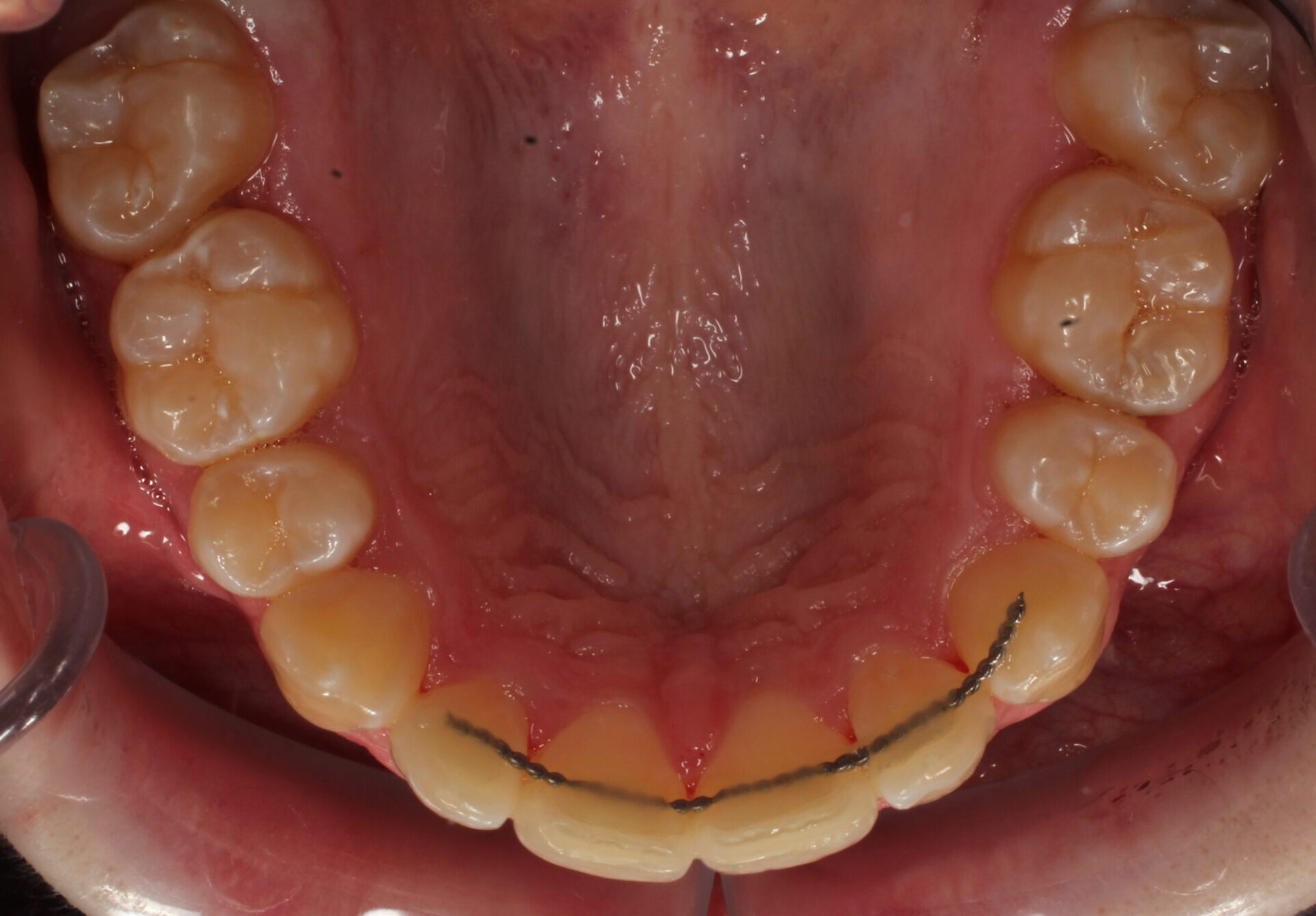 After braces upper teeth