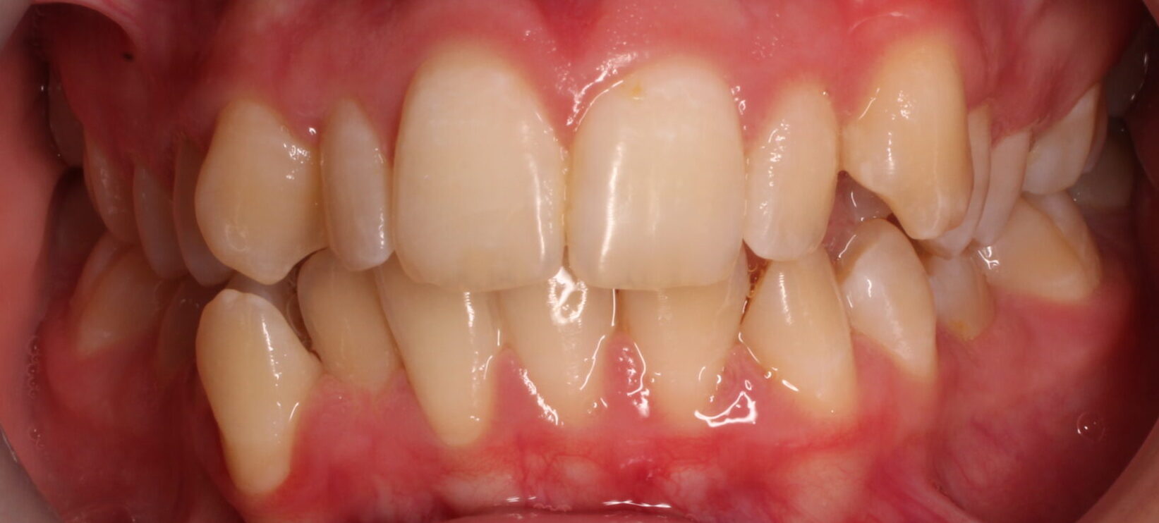 Before braces front teeth