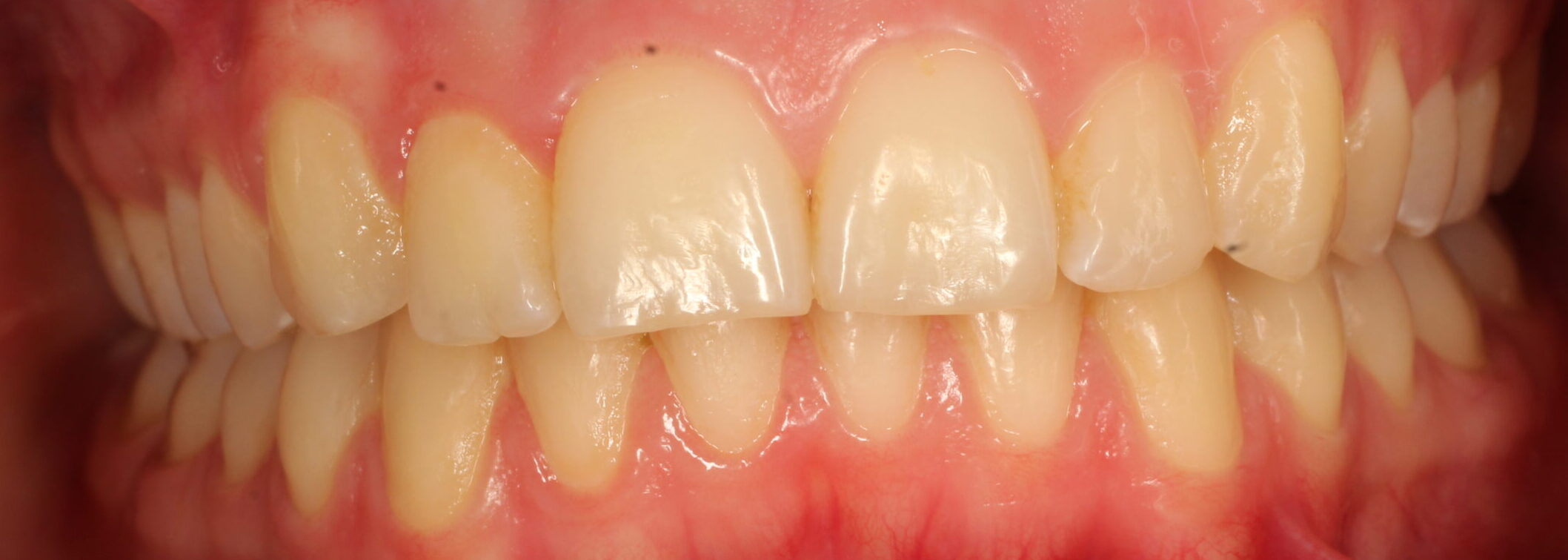 After braces front teeth