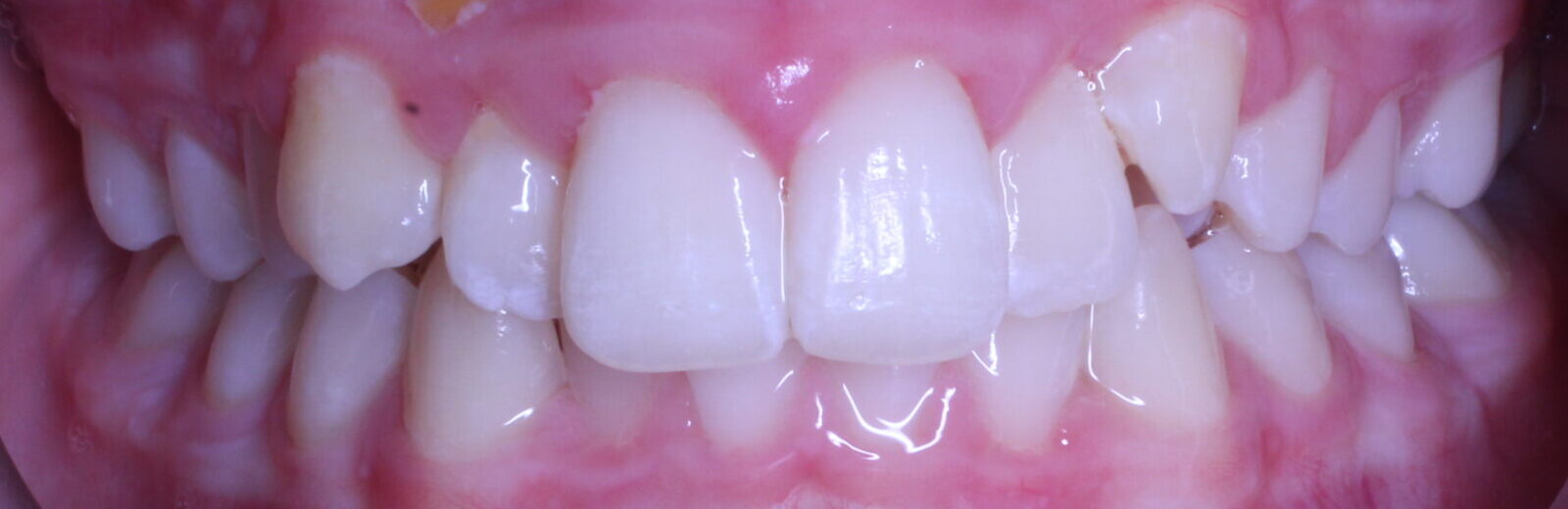 Before braces front teeth