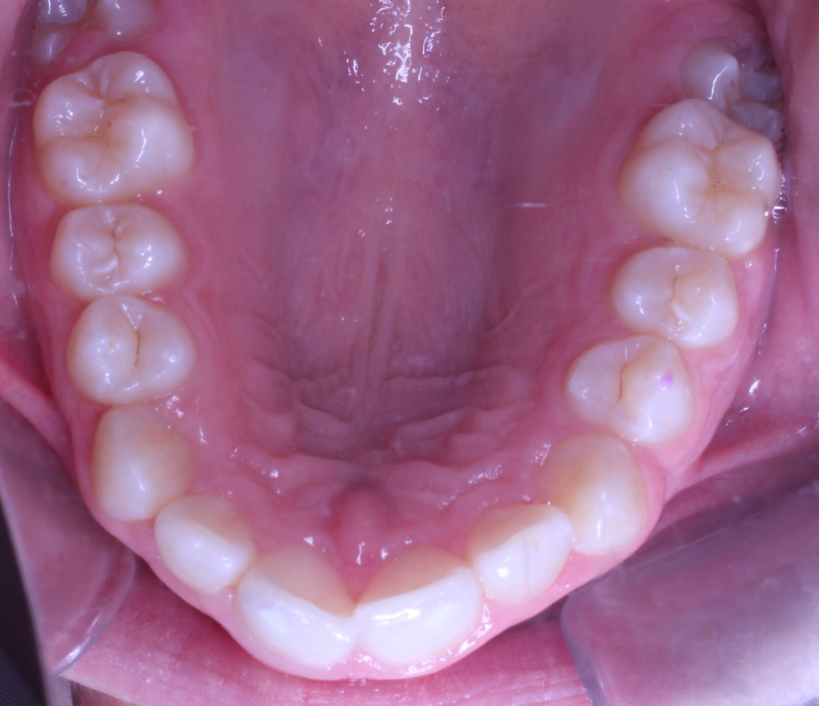 Before braces upper teeth