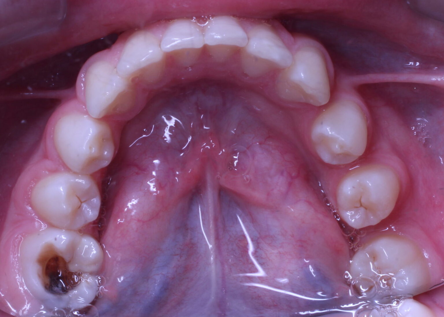 Before braces lower teeth