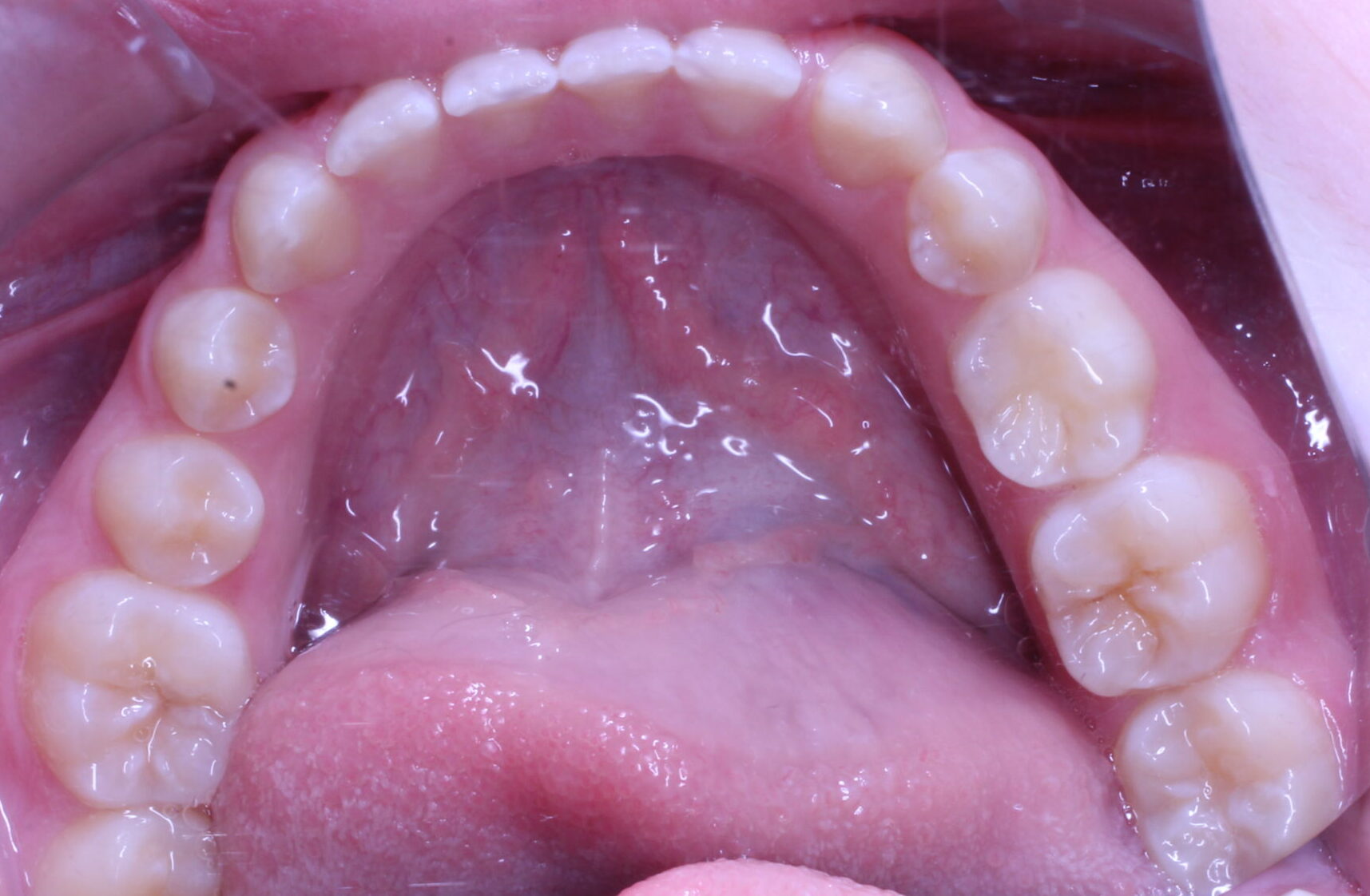 Before braces lower teeth
