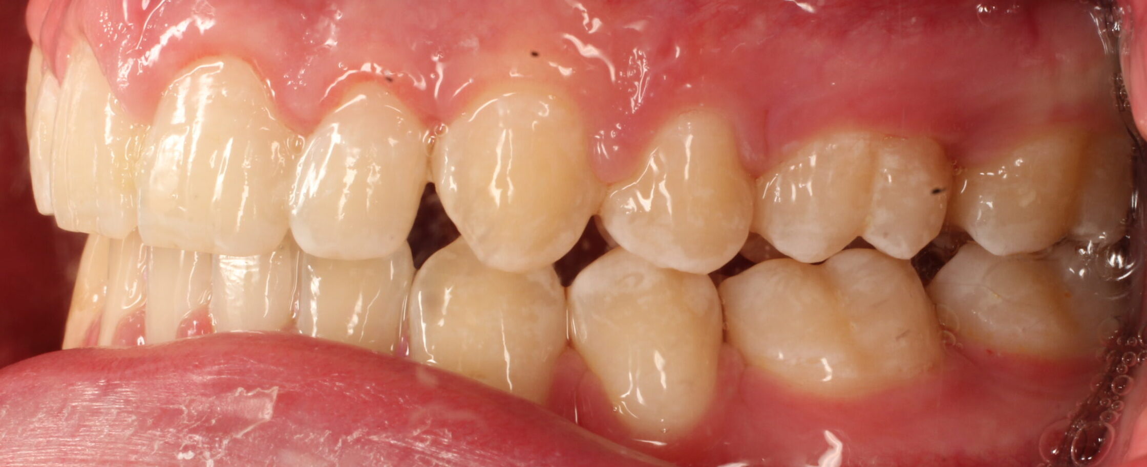 After braces left teeth