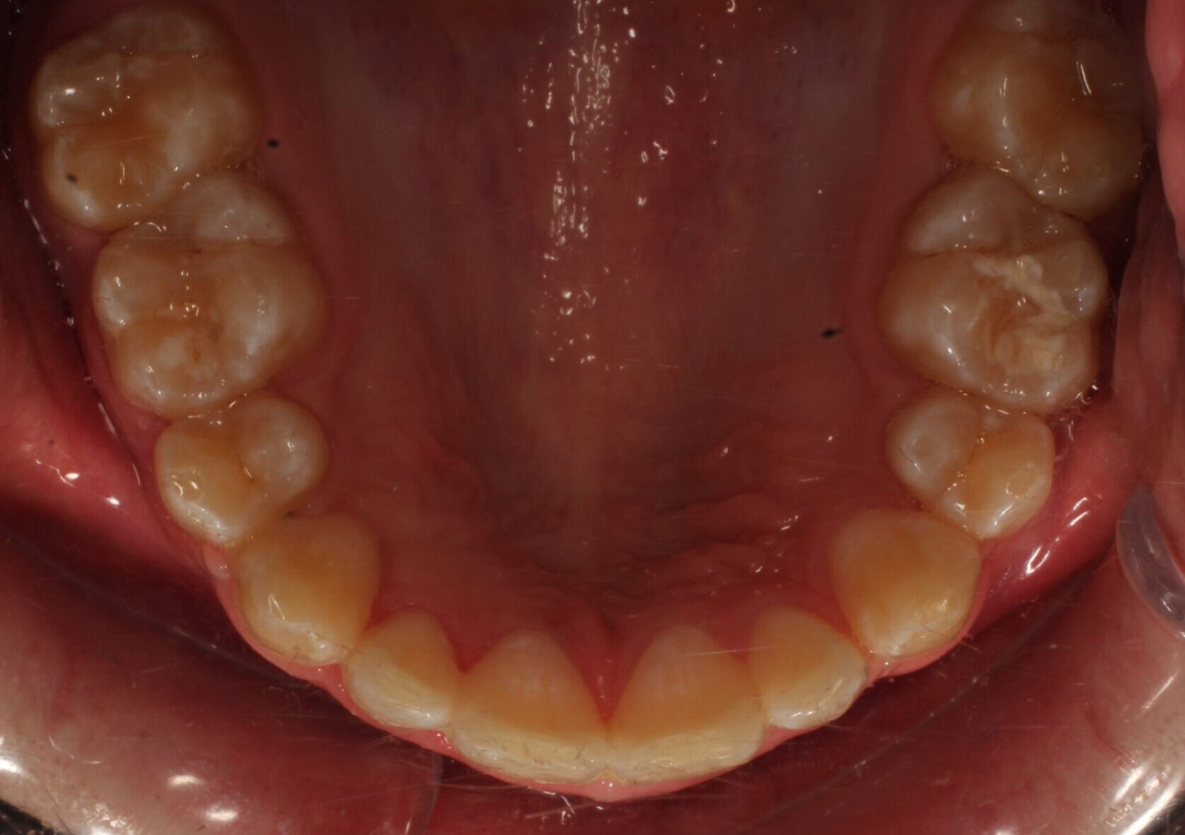 After braces upper teeth