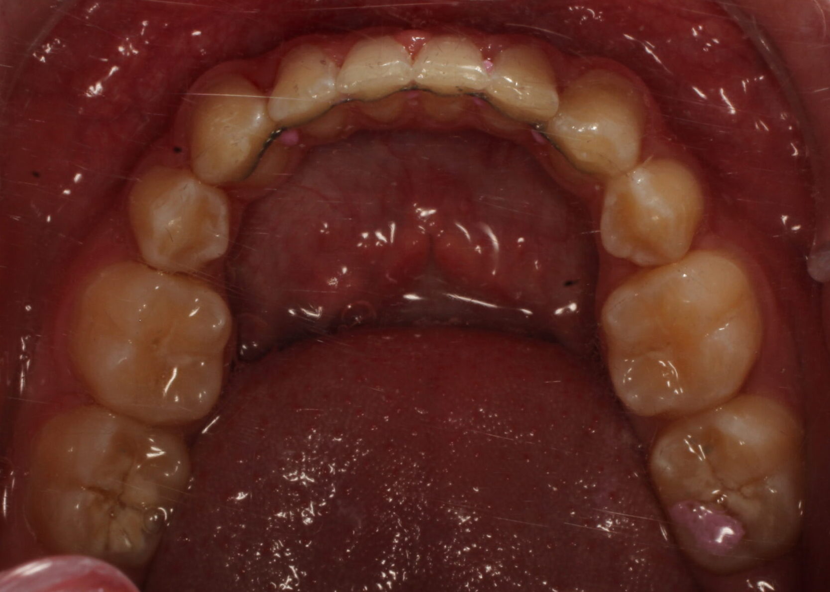 After braces lower teeth