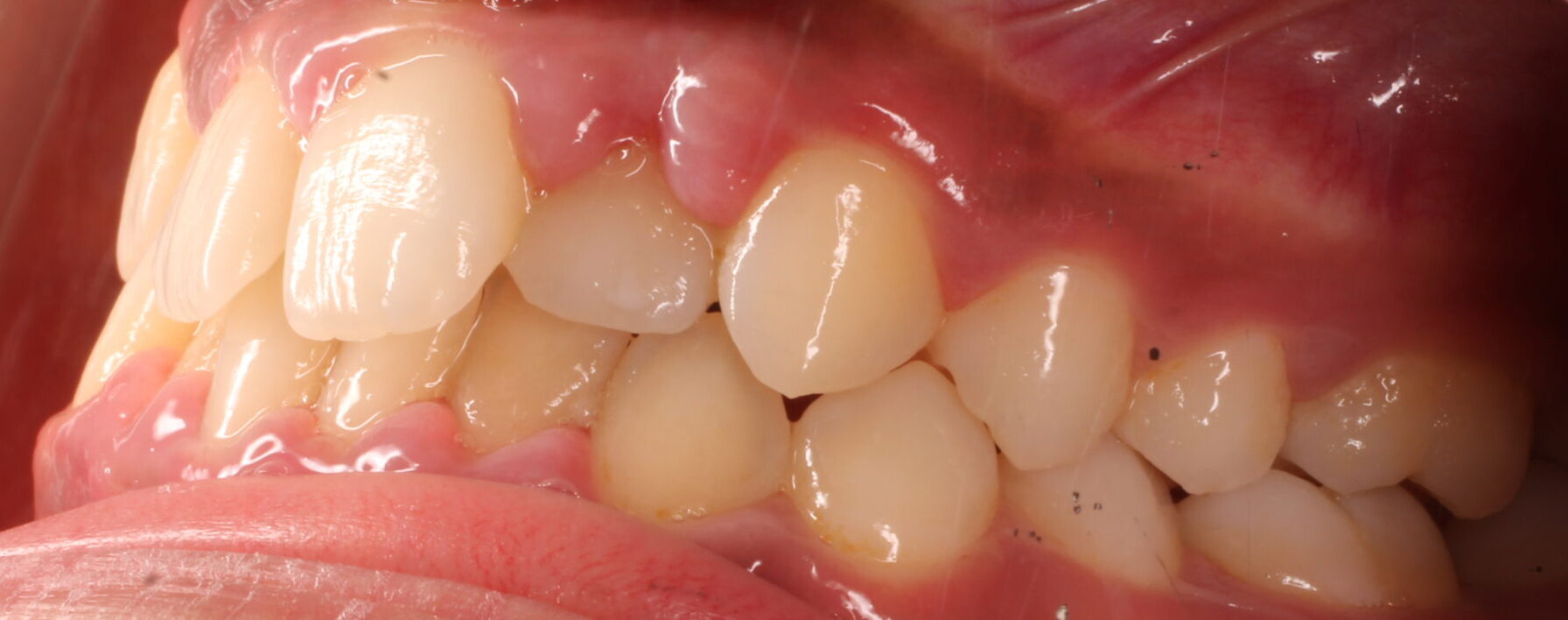 Before braces left teeth