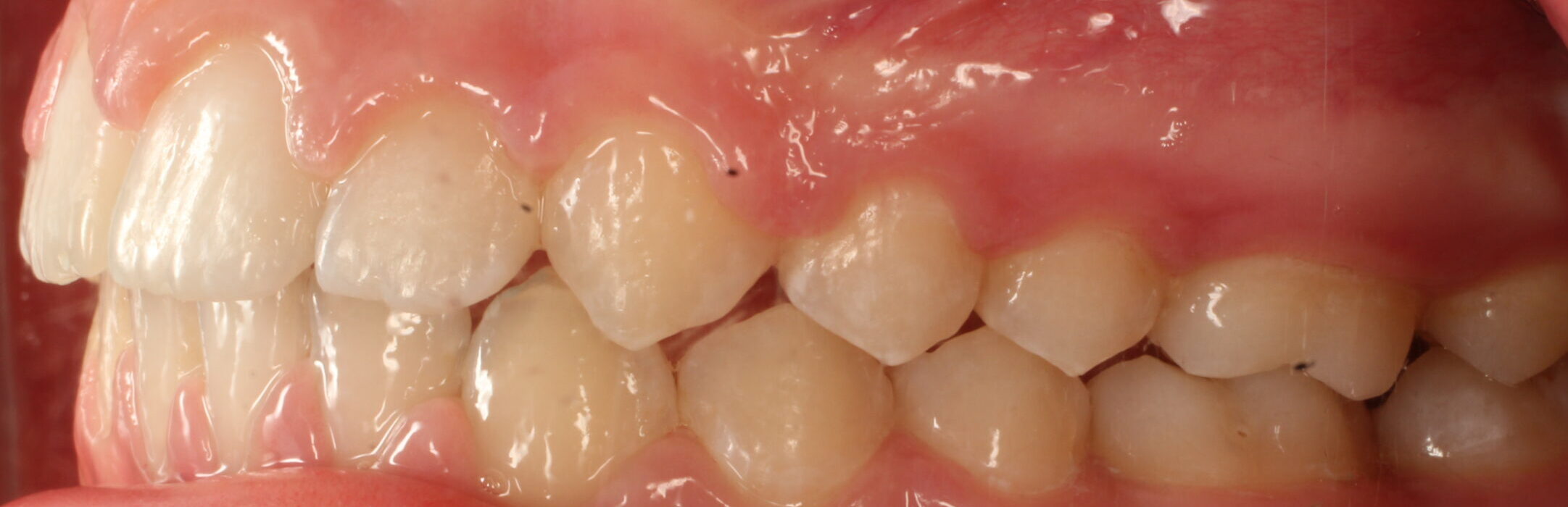 After braces left teeth