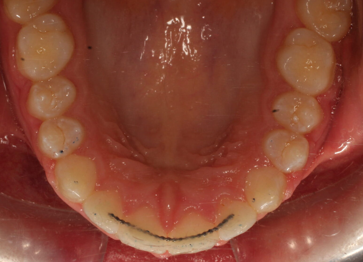 After braces upper teeth